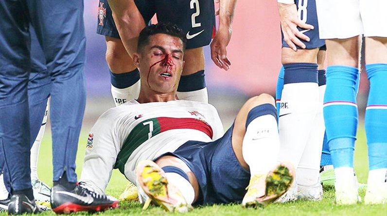 Последствия столкновения Роналду с Вацликом: под глазом у Криша красуется огромный синяк