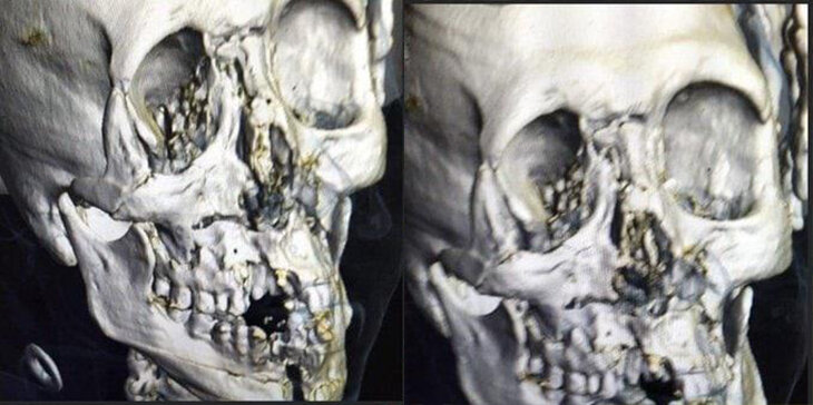 Рентгеновский снимок Яссера Аль-Шахрани