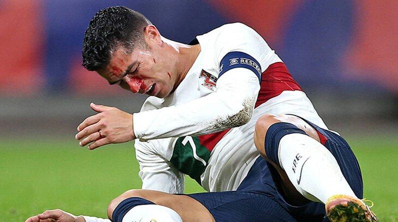 Жуткое столкновение Роналду и Вацлика: Кришу разбили нос, кровь залила лицо